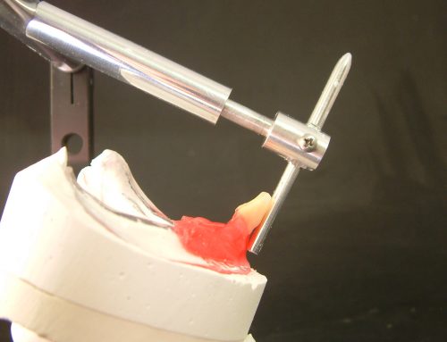 Total removable prosthesis protocol